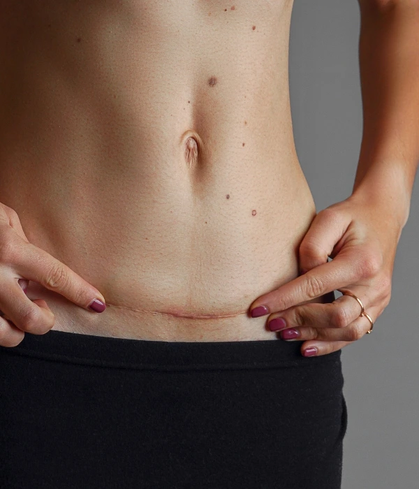 Cesárea Ginecóloga en Colima