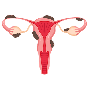 endometriosis Ginecología y Obstetricia en Colima