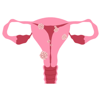 miomas Ginecología y Obstetricia en Colima